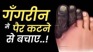 Gangrene  Prevent Amputation  Dr Vivek Jaju  Hindi [upl. by Harris]