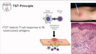 Tuberculosis Diagnosis [upl. by Rhyne]