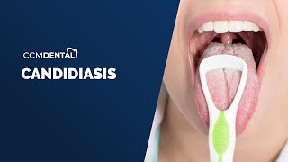 Candidiasis Oral  Síntomas causas y tratamiento por Javier Alberdi CCM Dental [upl. by Clorinda]