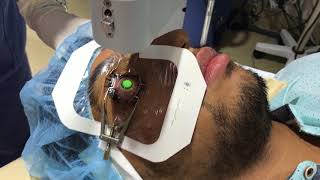 Corneal Crosslinking Procedure for Keratoconus [upl. by Ahsilla]