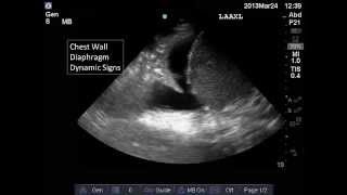 Lung and Pleural Ultrasound Interpretation [upl. by Herrington327]