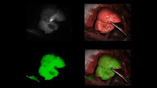 Intraoperative Lung Tumor Margin Visualization Using Indocyanine Green Inhalation [upl. by Attiuqaj]