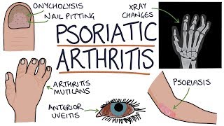 Psoriatic Arthritis [upl. by Harras698]