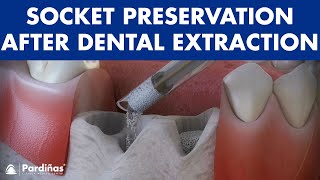 Tooth extraction  Treatment for socket preservation © [upl. by Thomson]