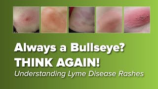 Think the Lyme Disease Rash is Always a Bullseye Think Again  Johns Hopkins Rheumatology [upl. by Vidovik11]