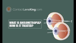 What is Anisometropia How is Anisometropia Treated [upl. by Ytisahcal]