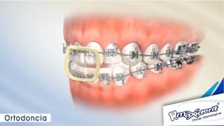 Corrección de mordida y espacios dentales quotOrtodonciaquot [upl. by Leamsi683]