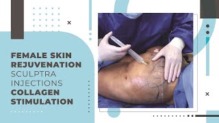 Female Skin Rejuvenation  Sculptra Injections  Collagen Stimulation [upl. by Walters]