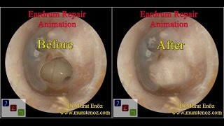 Ear Drum Repair [upl. by Isma]