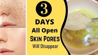 3 Days and All Open Pores Will Disappear from Your Skin Forever [upl. by Attenna97]