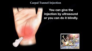 Carpal Tunnel Injection  Everything You Need To Know  Dr Nabil Ebraheim [upl. by Ehsrop]