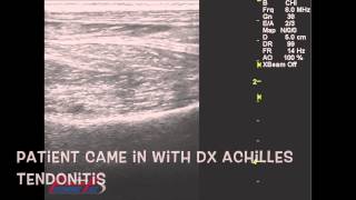 How to read MSK Ultrasound Achilles Tendon [upl. by Noinatrad]