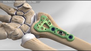 Distal Radius Fracture Repair  Volar Plate [upl. by Taddeusz]