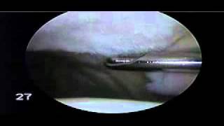 Chondroplasty Patella for Chondromalacia Patella  Dr Steven Struhl [upl. by Furgeson]