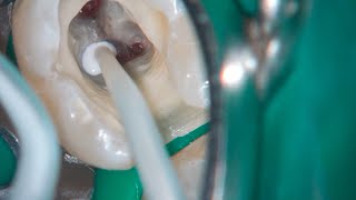 DRendo  Full pulp chamber pulpotomy in a mandibular second molar [upl. by Bopp611]