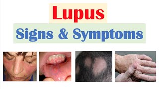 Lupus Signs amp Symptoms amp Why They Occur  Skin Joints Organ Systems [upl. by Luane]