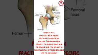 HIP HEMIARTHROPLASTY [upl. by Nnylanna]