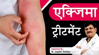 एक्जिमा ट्रीटमेंट Treatment  How to get rid of Eczema  Sakhiya Skin Clinic  Dr Jagdish Sakhiya [upl. by Layne]