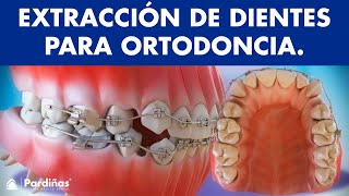 Extracción de dientes en ortodoncia © [upl. by Fidel]