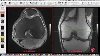 Systematic Interpretation of Knee MRI How I do it [upl. by Ymled]