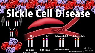 Sickle Cell Disease Animation [upl. by Ahsietal]