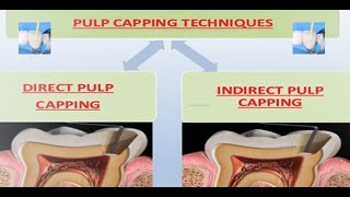 PULP CAPPING Procedure and pulp capping a case report [upl. by Rodnas770]