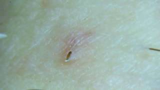 Gross Removing an ingrown pubic hair [upl. by Abdella450]