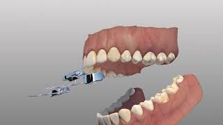 Rapid Palatal Expander [upl. by Estevan]