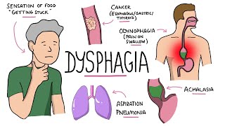 Dysphagia  Oropharyngeal amp Esophageal Dysphagia CausesDifferential Diagnosis Signs Treatment [upl. by Hay]