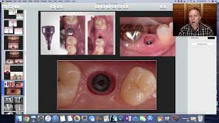 Implant Healing Abutments Education for dental staff [upl. by Babs]