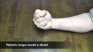 Thompsons Test for Palmaris Longus CR [upl. by Aneliram400]