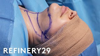 Double Chin Removal Surgery  Macro Beauty  Refinery29 [upl. by Anneuq369]