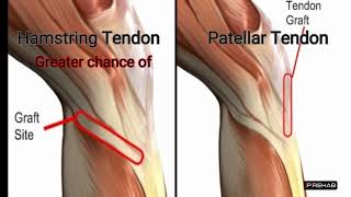 ACL Reconstruction Graft Options [upl. by Doykos260]