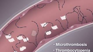 Thrombocytopenia Hemostasis  Lesson 8 [upl. by Airamesor]