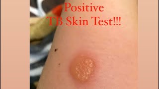 POSITIVE TB SKIN TEST [upl. by Arndt597]