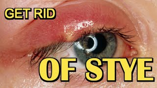 How To Get Rid Of Stye Fast  Removal At Home [upl. by Conard501]