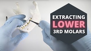 How To Extract Erupted Lower Third Molars  OnlineExodontiacom [upl. by Gleeson462]