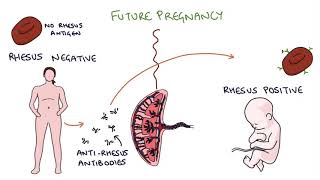 Understanding Rhesus Status and AntiD in Pregnancy [upl. by Aitnwahs]