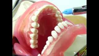 Maxillary Infiltration Technique [upl. by Adali]