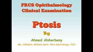 FRCS Ophthalmology Clinical Examination  Ptosis [upl. by Anyale]