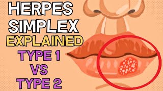 Herpes Simplex  Type 1 vs Type 2  EXPLAINED IN 2 MINUTES [upl. by Suoicerpal]