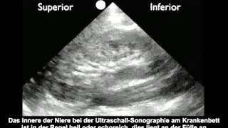 Anleitung Nierenultraschall – Hydronephrose [upl. by Nivag]