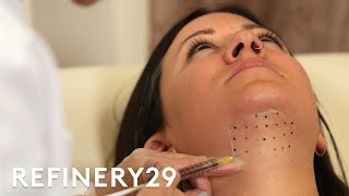 Kybella Double Chin Removal Treatment Up Close  Macro Beauty  Refinery29 [upl. by Aneladgam907]