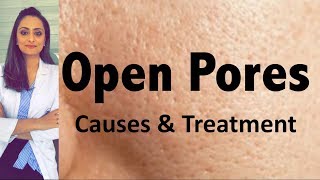 Open Pores Causes amp Treatment  Dermatologists opinion  Dr Aanchal Panth [upl. by Katerina]