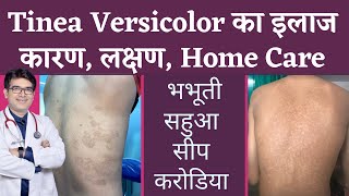 Tinea Versicolar Treatment  भभूतीसीपसहुआकरोडिया का इलाज  Pityriasis Versicolor  In Hindi [upl. by Clarkson]