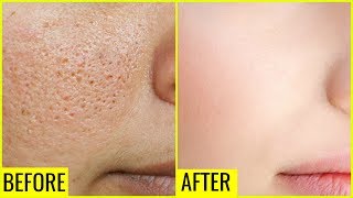 How to Get Rid of Large OPEN PORES Permanently  Anaysa [upl. by Merrill]