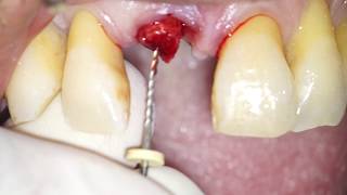 Atraumatic Root Extraction by means of an endodontic file  Dr Fabio Cozzolino [upl. by Innig]