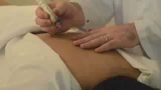 Demonstration of Moxibustion Treatment [upl. by Ayortal357]