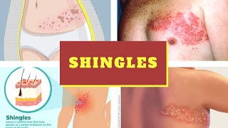 Diagnosed With Herpes 3 Things You Should Remember [upl. by Ada674]