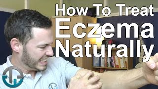 How To Treat Eczema Naturally [upl. by Irdua]